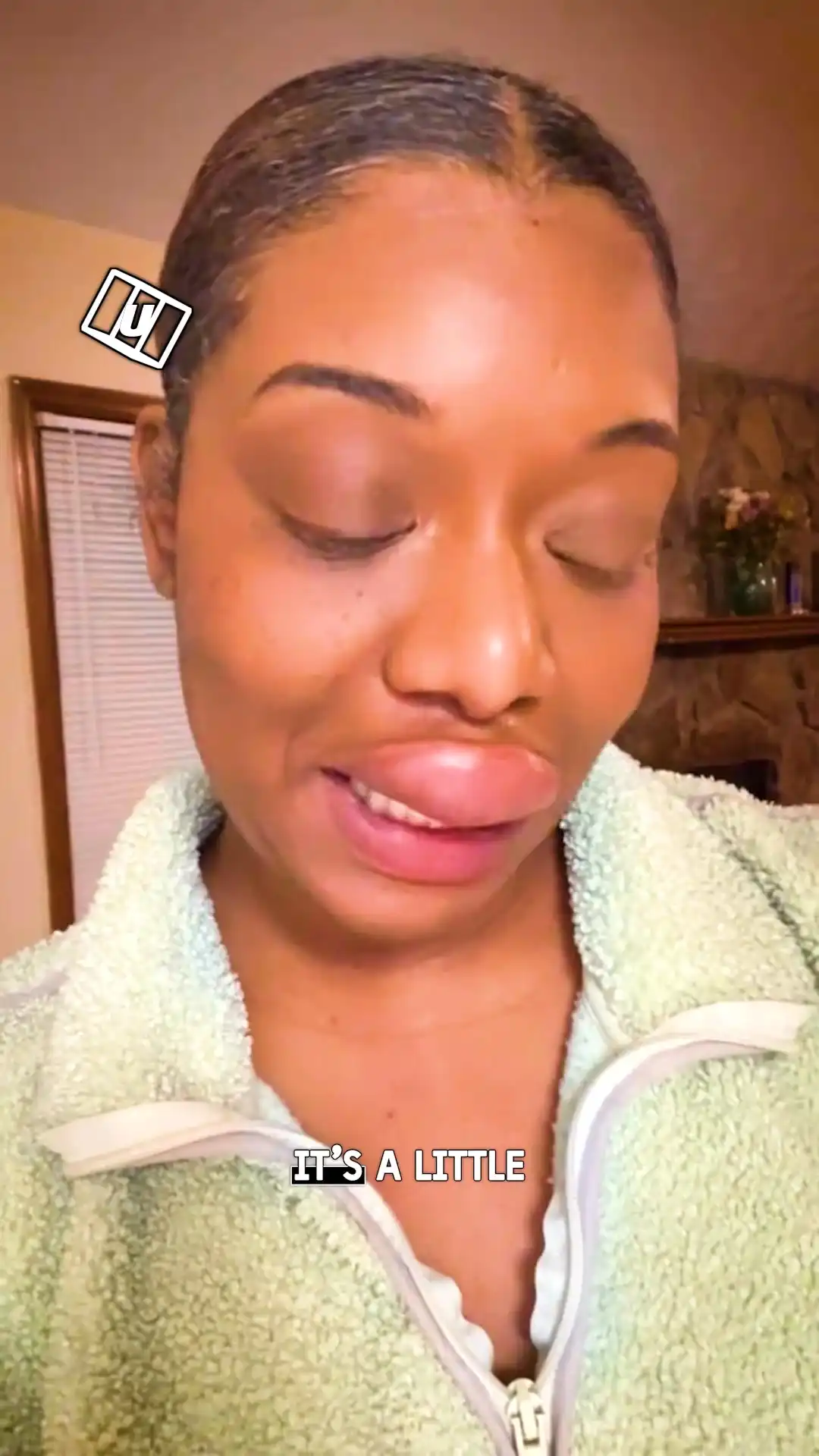 Swollen lip before my date