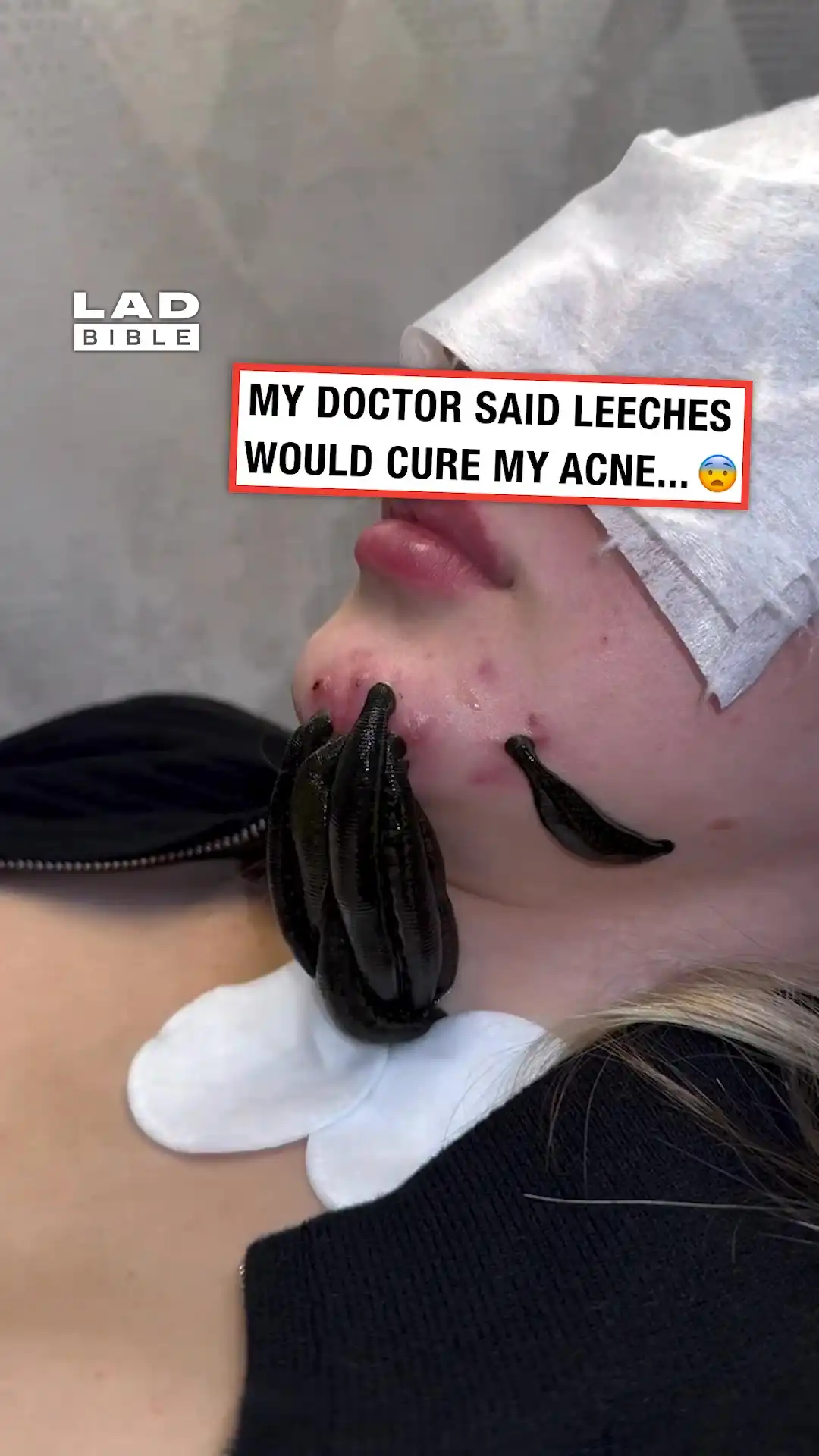 Leech Skin Therapy 😨