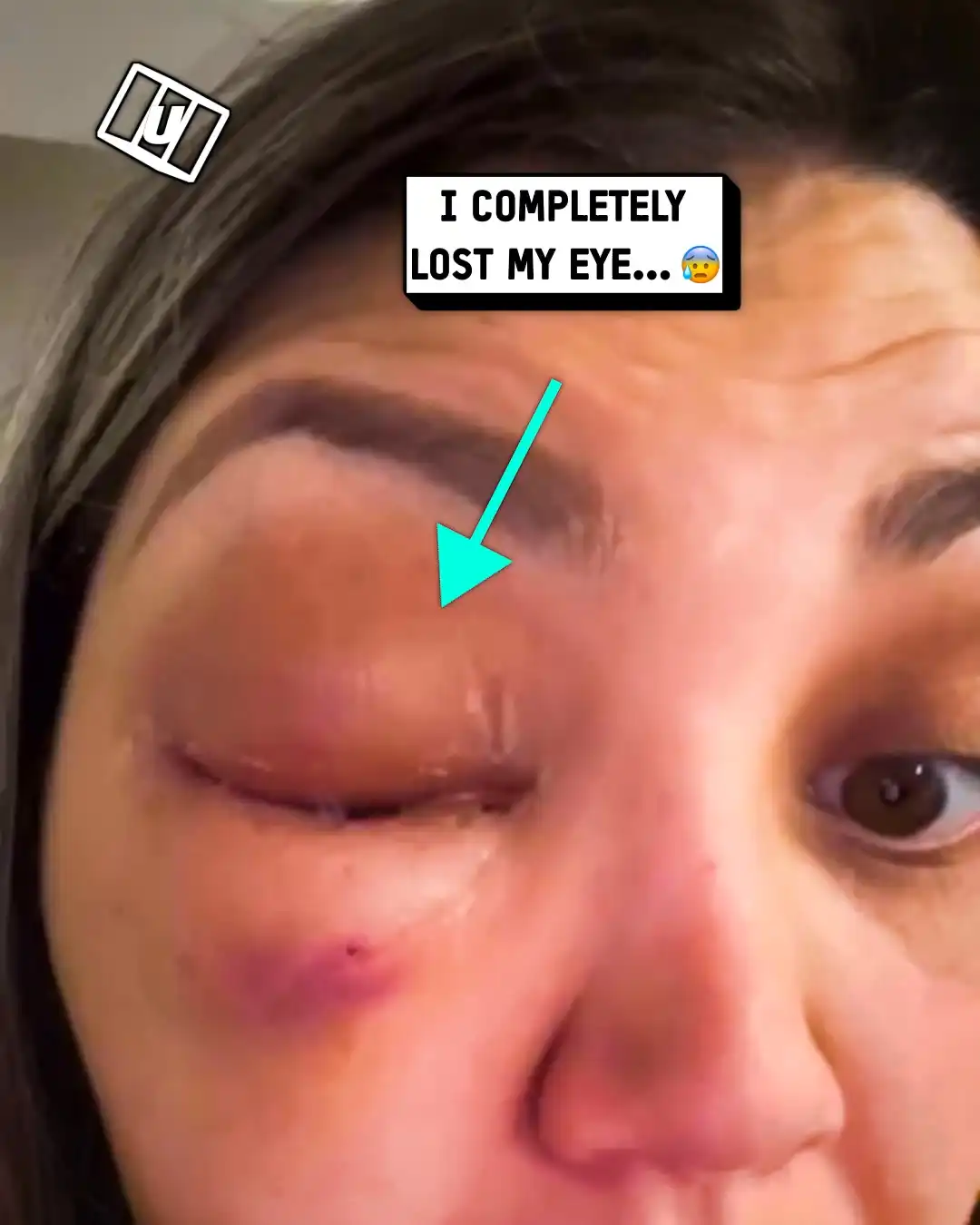 Eye recovery with prosthetic