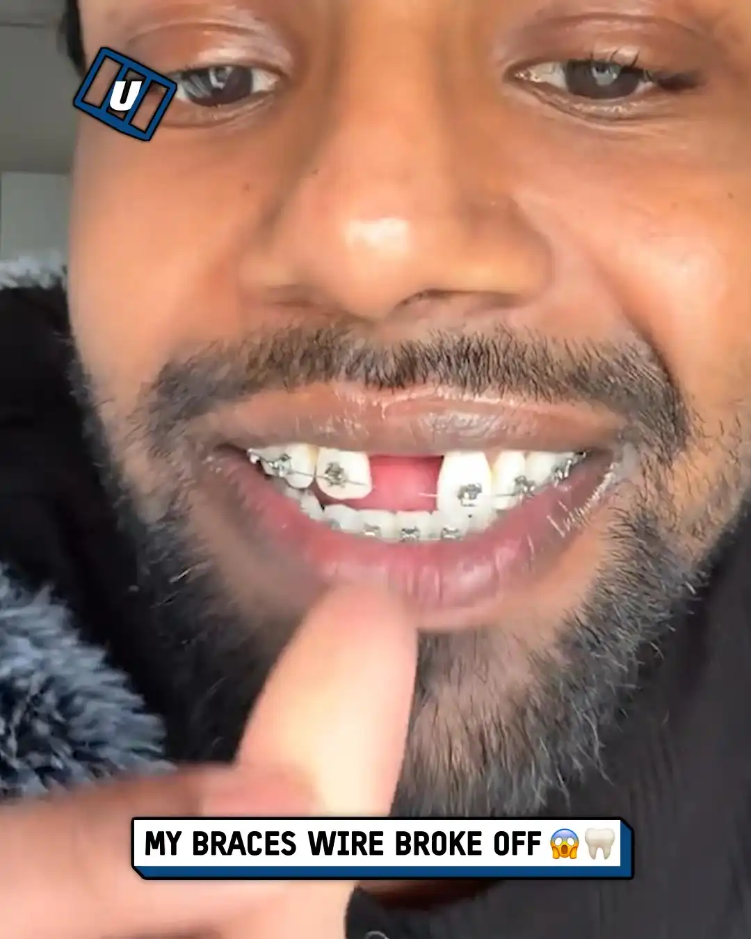 Fixing broken braces 🦷😱