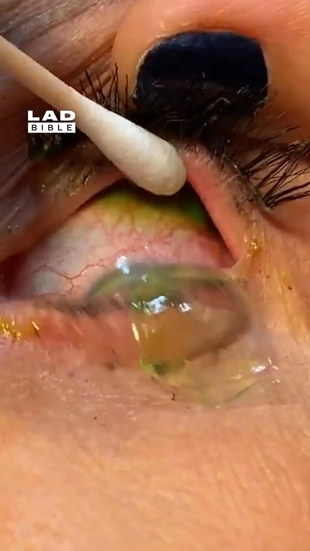 I had 23 contact lenses in my eye 👀😰