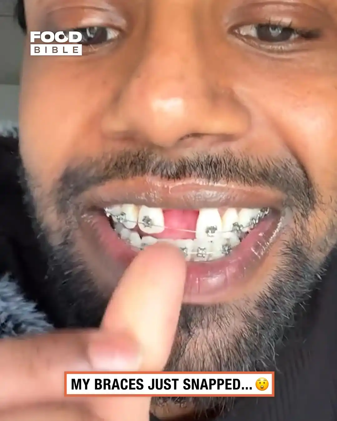 His braces have broken 🦷