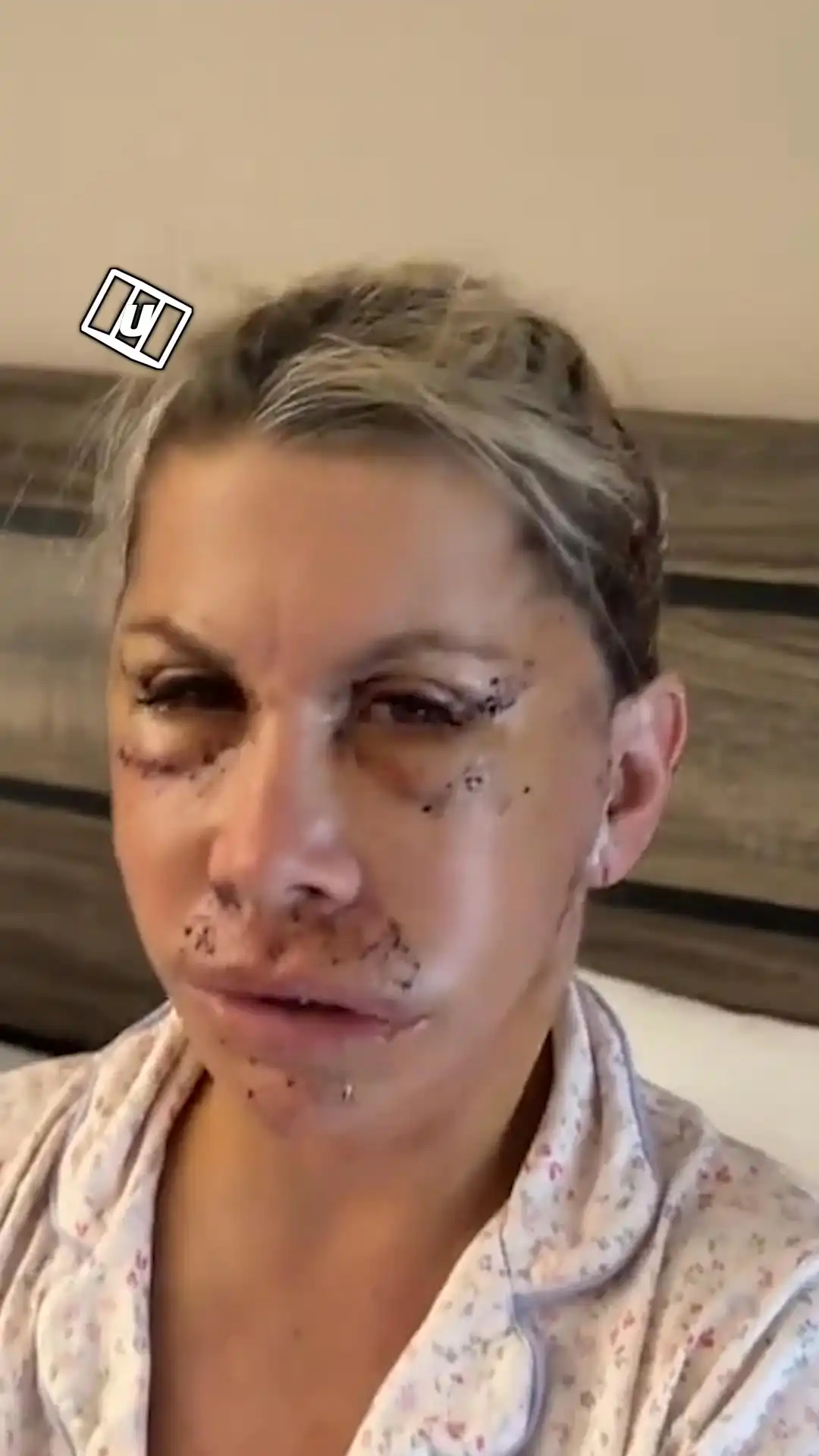 Mom recovering from a face lift