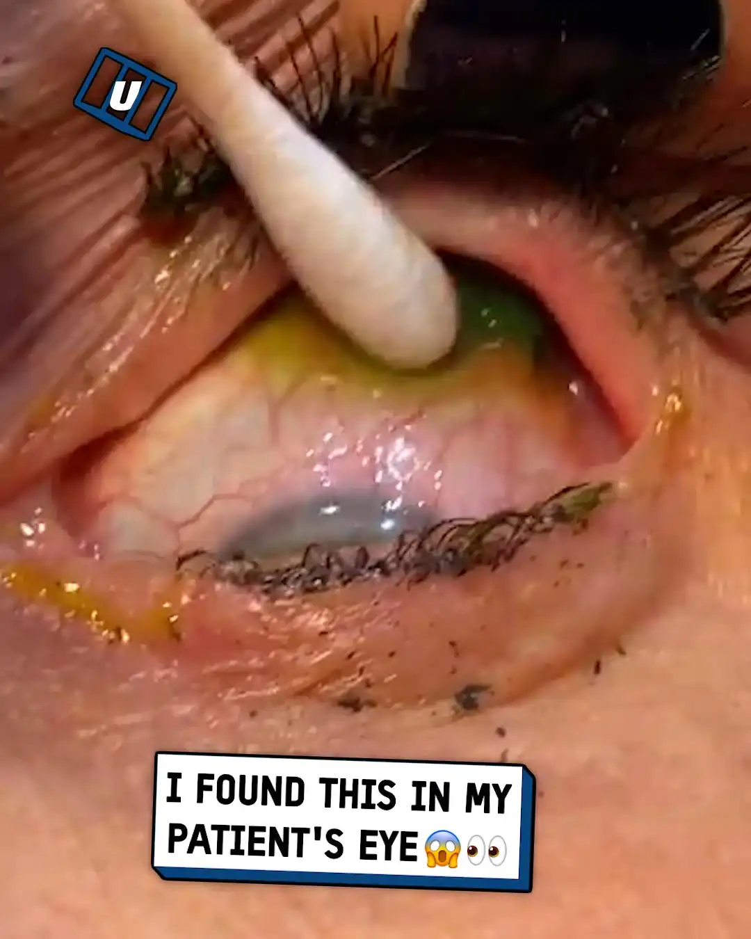 Doctor Removes 23 Contact Lenses From Patient's Eye 👁️