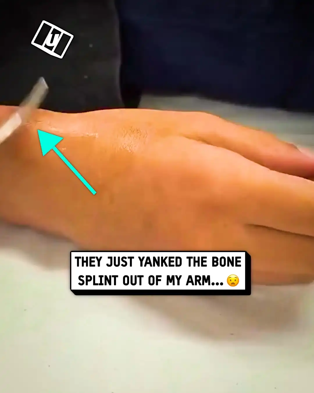 Bone splint pulled out 😳🦴