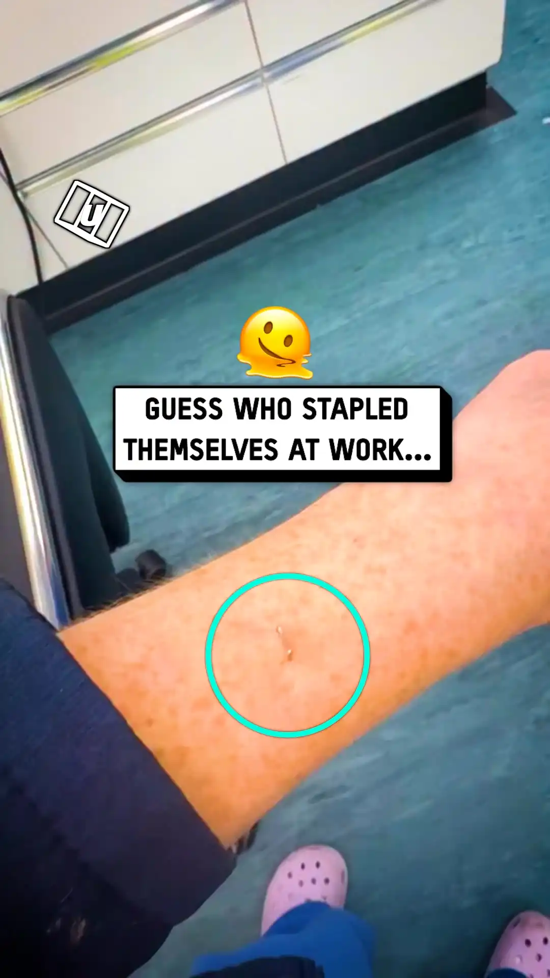 Pulling a staple from my arm 💀