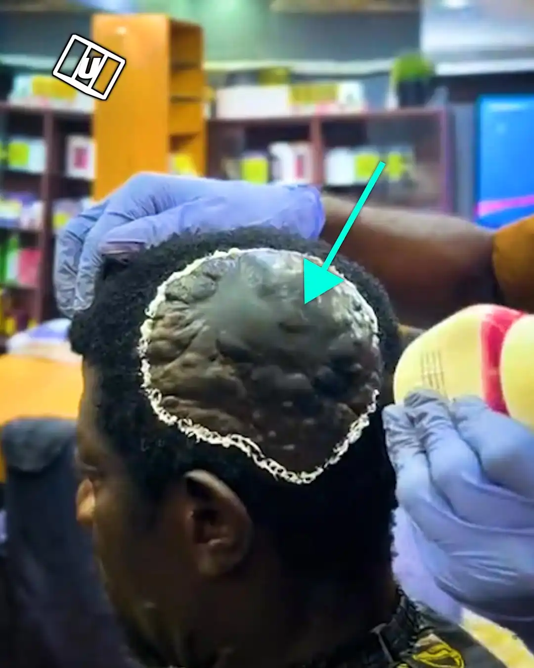 Covering up my scars with this 💇‍♂️