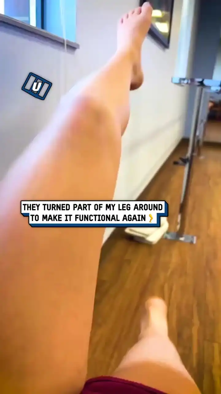 They reattached my leg backwards... 🦵🤯 #fblifestyle