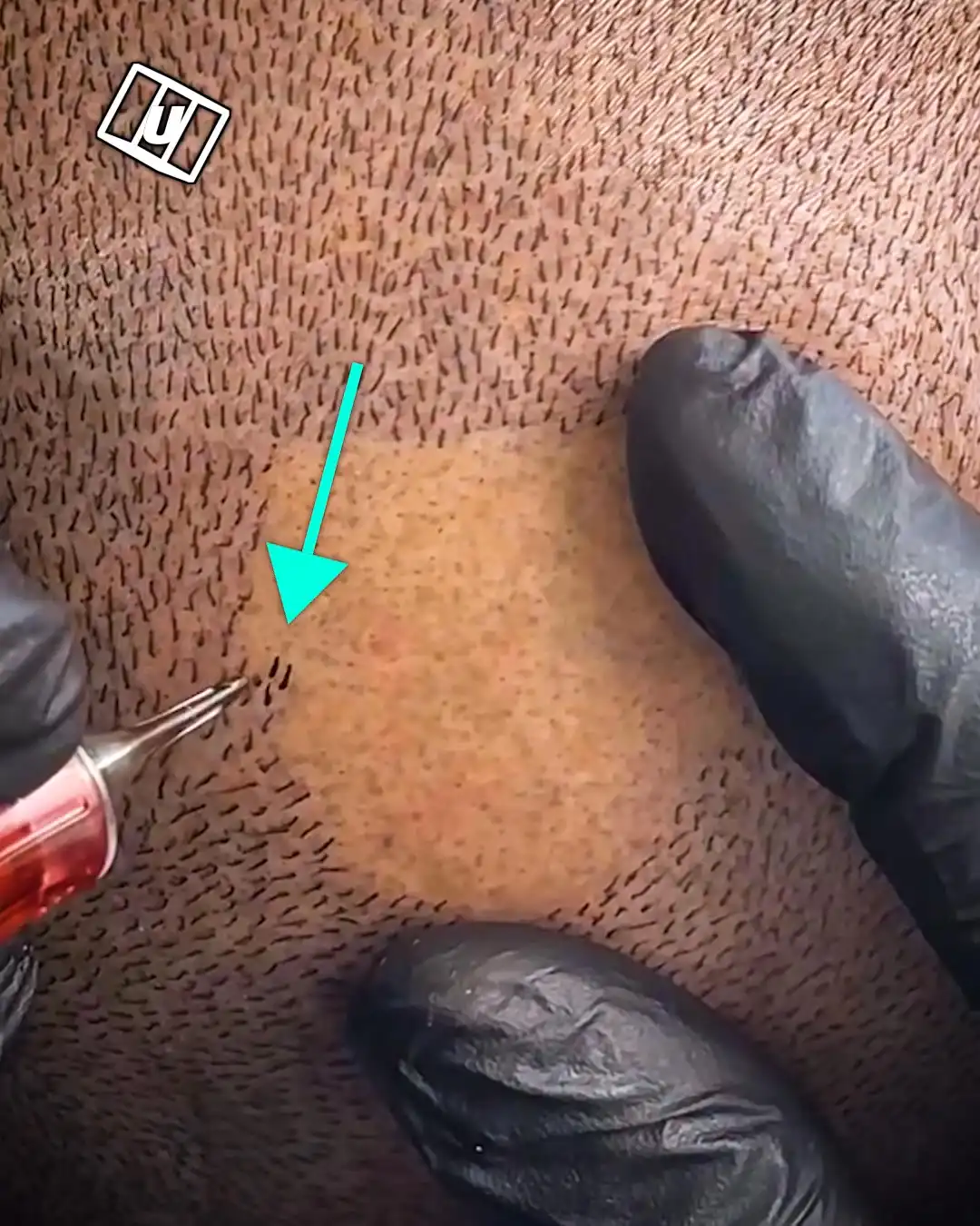 Getting my hair tattooed 😅