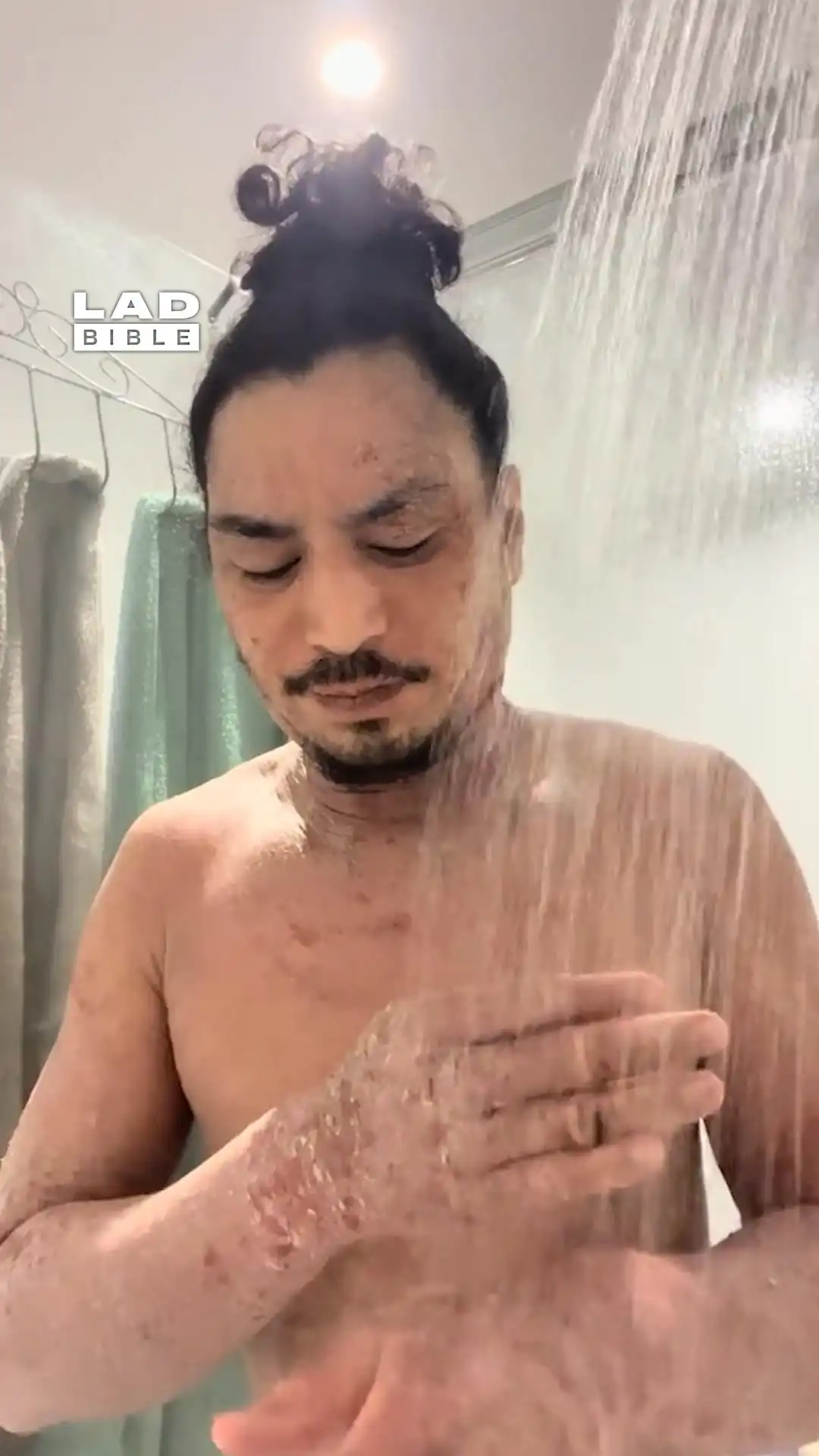 Battling topical steroid withdrawals 😰