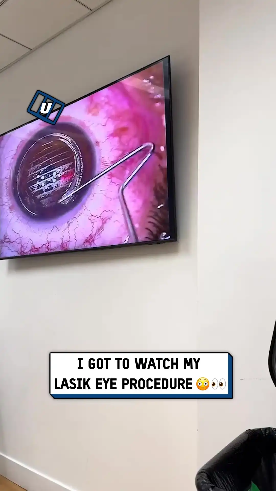 9x16 Lasik surgery process  ST00160524