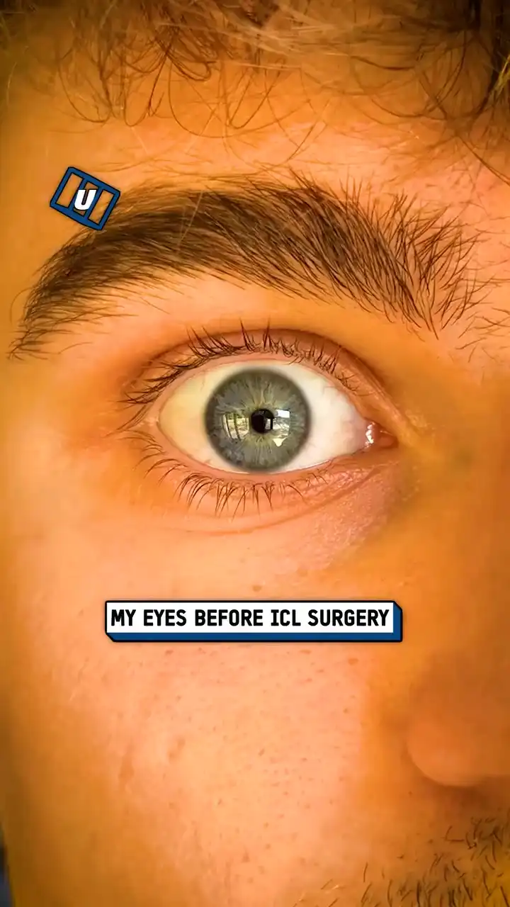 How my eyes looked before and after ICL surgery 👀🤯 #fblifestyle