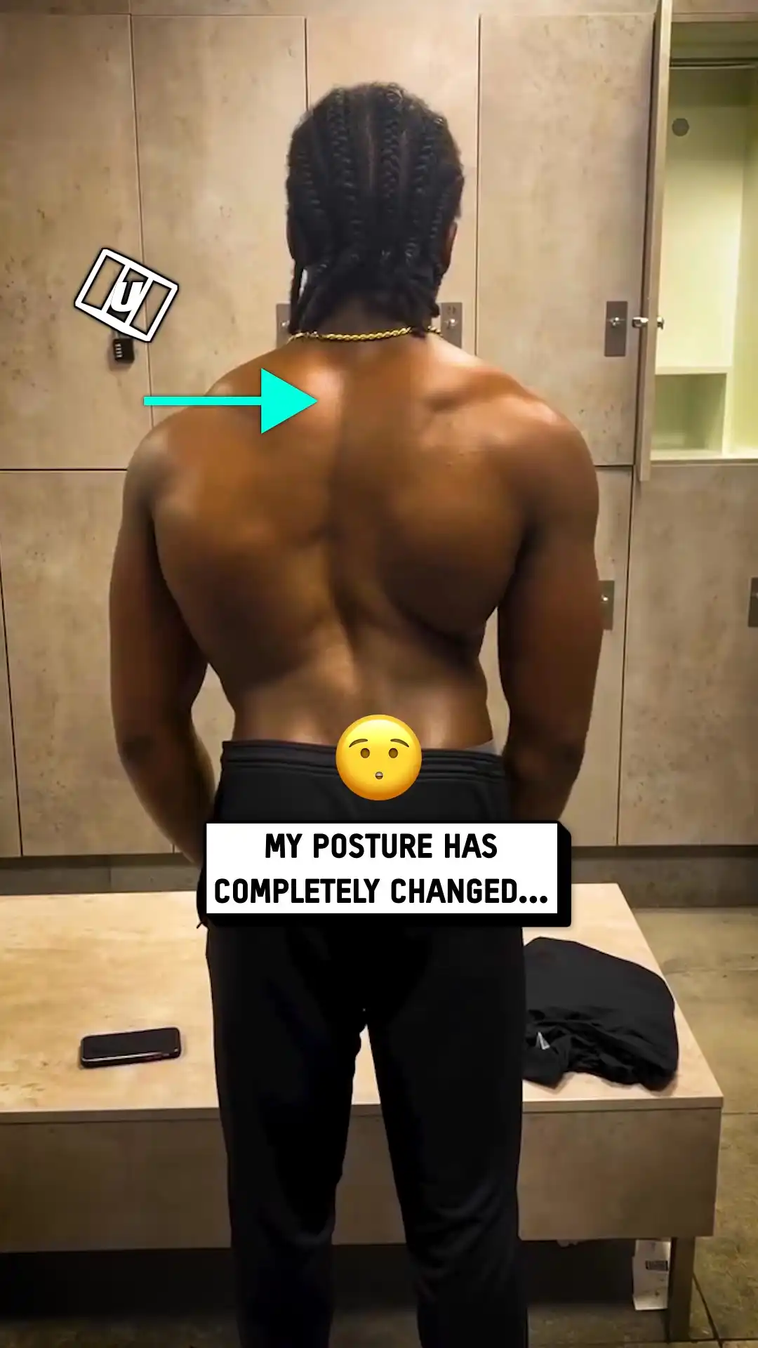 Scoliosis journey after surgery