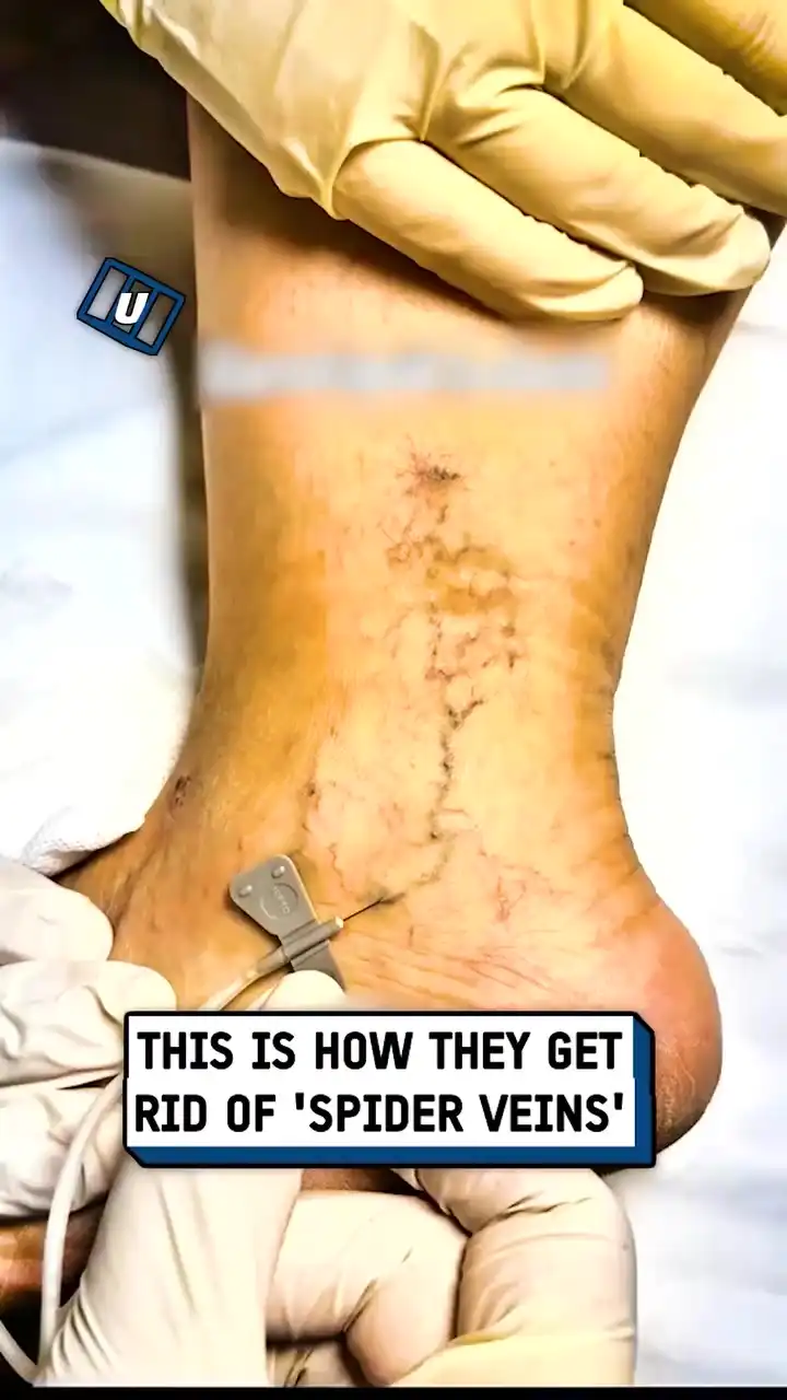 How Spider Veins are Removed 💉