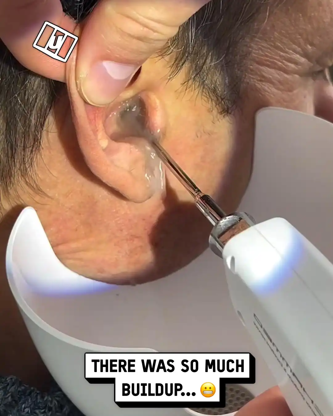 Cleaning out major ear wax blockage 😳👂