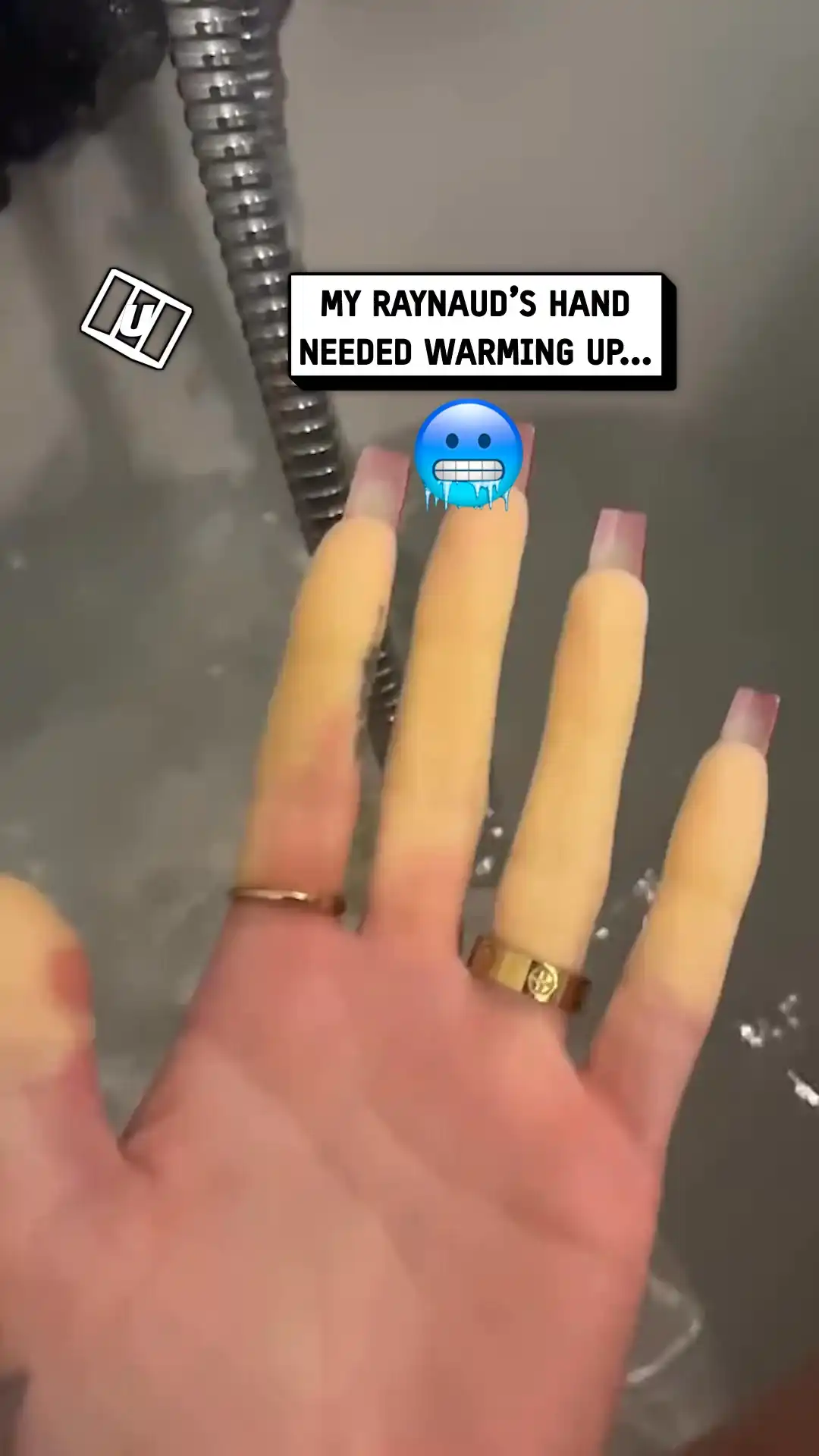 Raynaud's hand warm up 🥶
