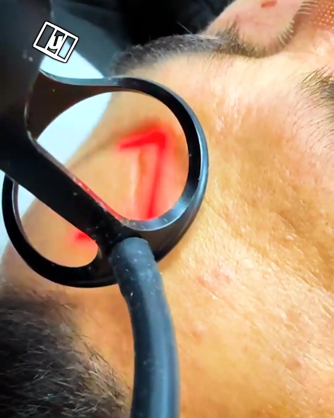 Laser removes my scars 😳