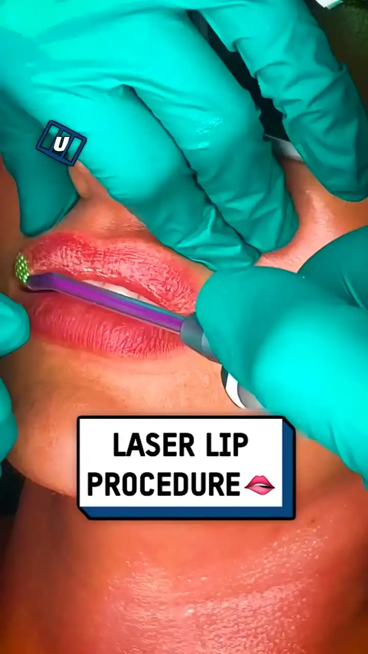 Laser lip procedure 👄💥