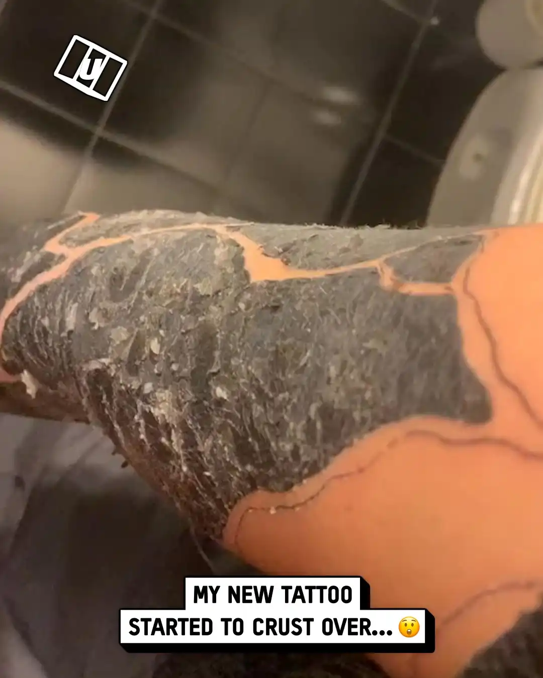 My black-out tattoo is crusting 🖤