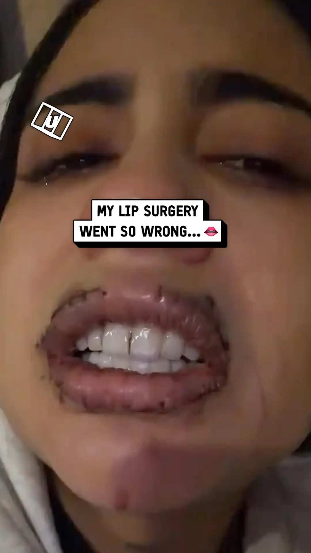 My lip surgery went wrong 😳