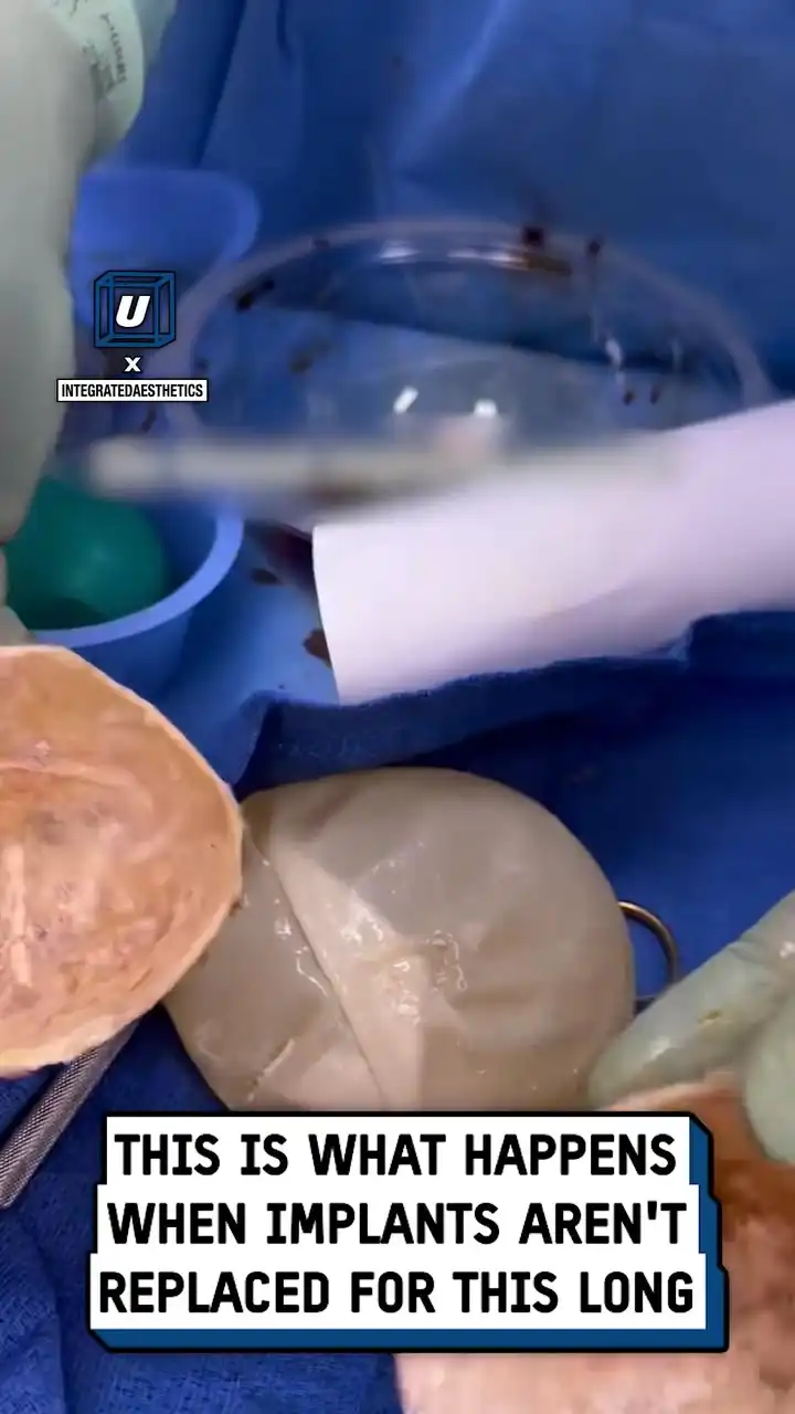 I never knew that implants could expire... π³π