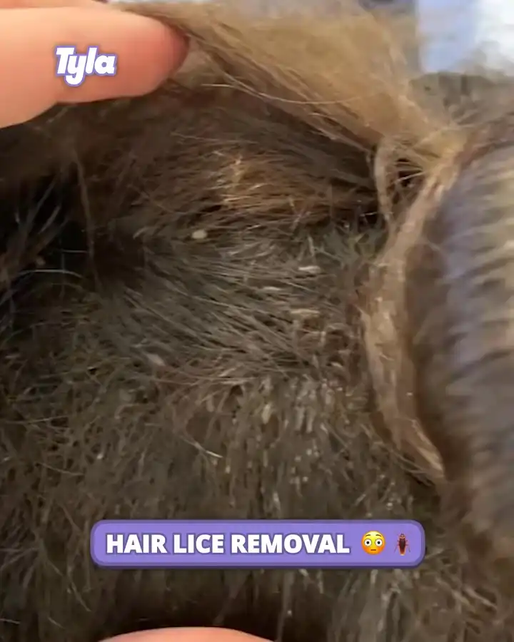 Hair lice removal 🪳😳