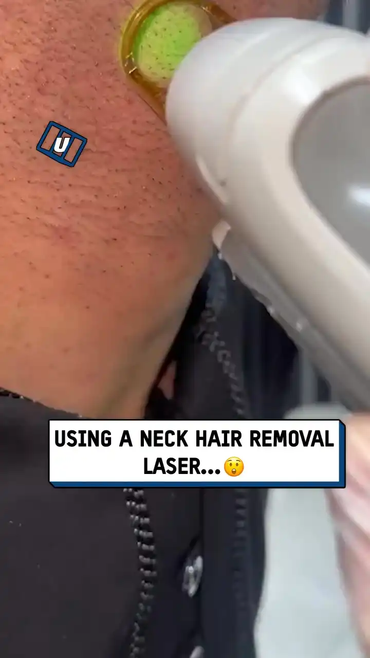 Neck hair laser removal gadget 🤯💥