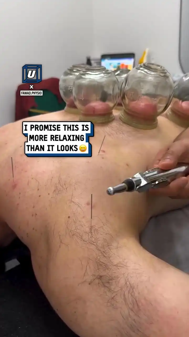 Dry needling e-stim reaction 😲⚡️
