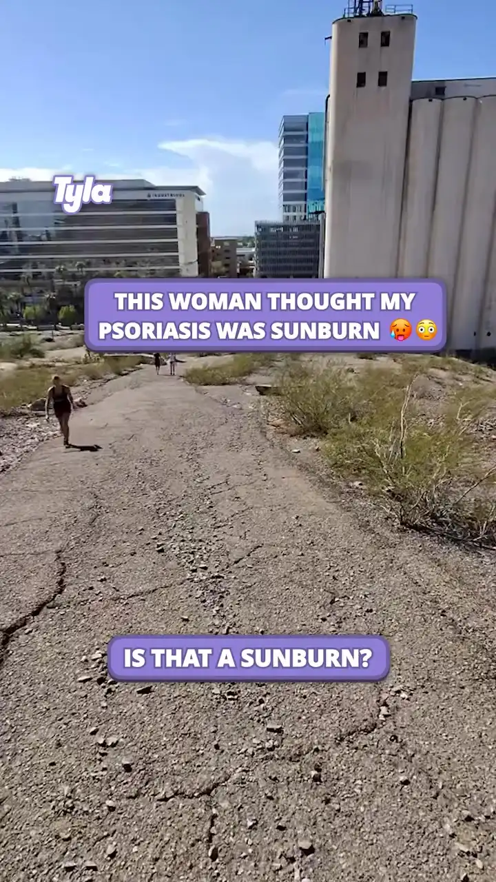 This woman thought my psoriasis was sunburn 😳