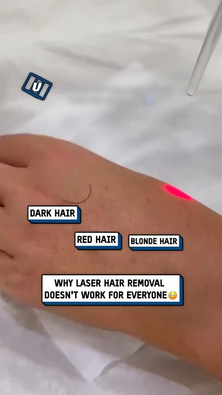 Why laser hair removal doesn't work for everyone 🤯💥