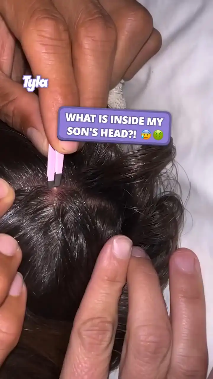 My son had a bot fly in his head 😳