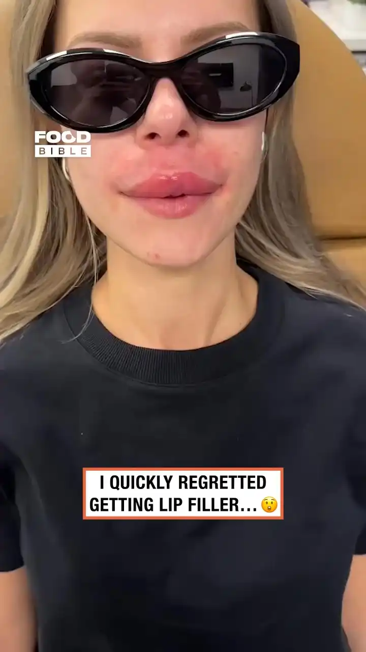Regretting getting lip filler 😬