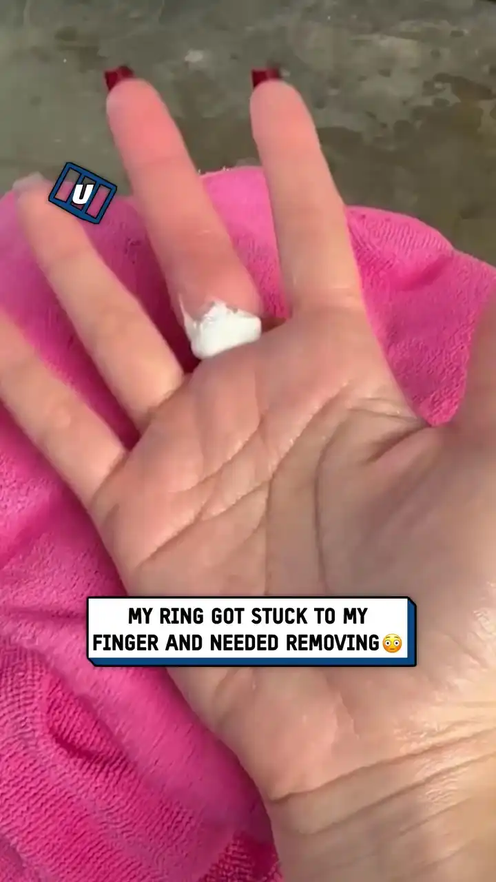 Sawing off a stuck ring 😲💍