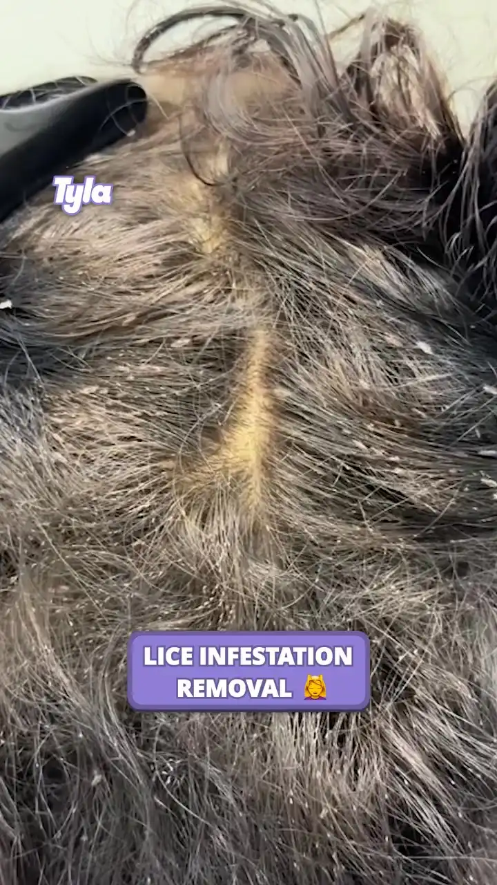 Lice Infestation Removal 💇‍♀️