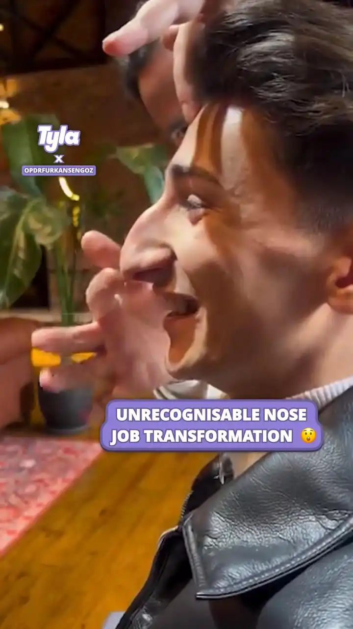 Amazing nose job transformation π€―