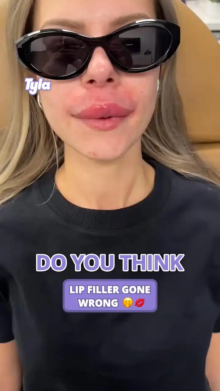 Lip filler gone wrong 😳