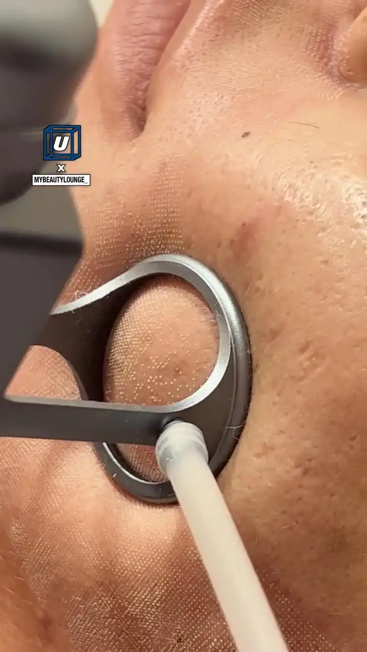 CO2 fractional laser treatment ππ₯