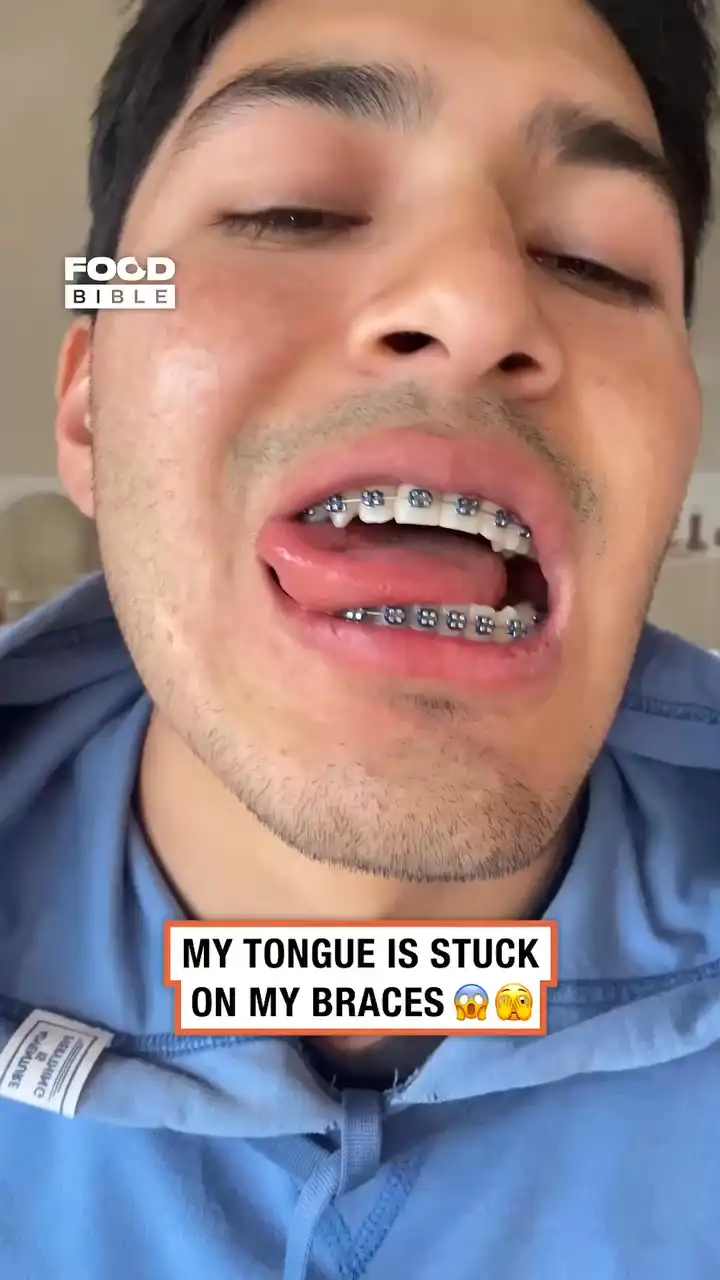 Braces get stuck on tongue 🫣