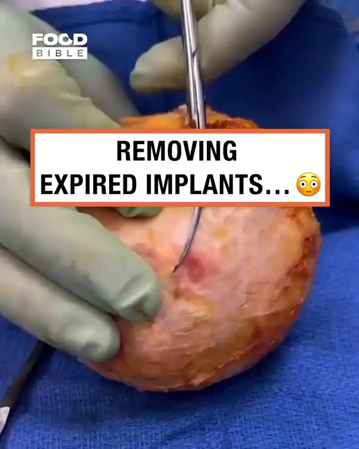 40 year old expired implants 😳