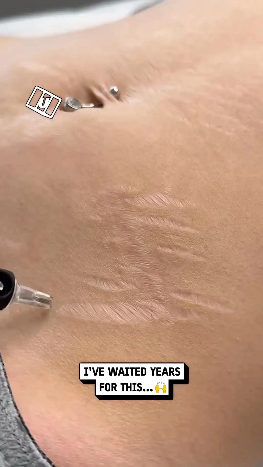 Getting my stretch marks tattooed 😲