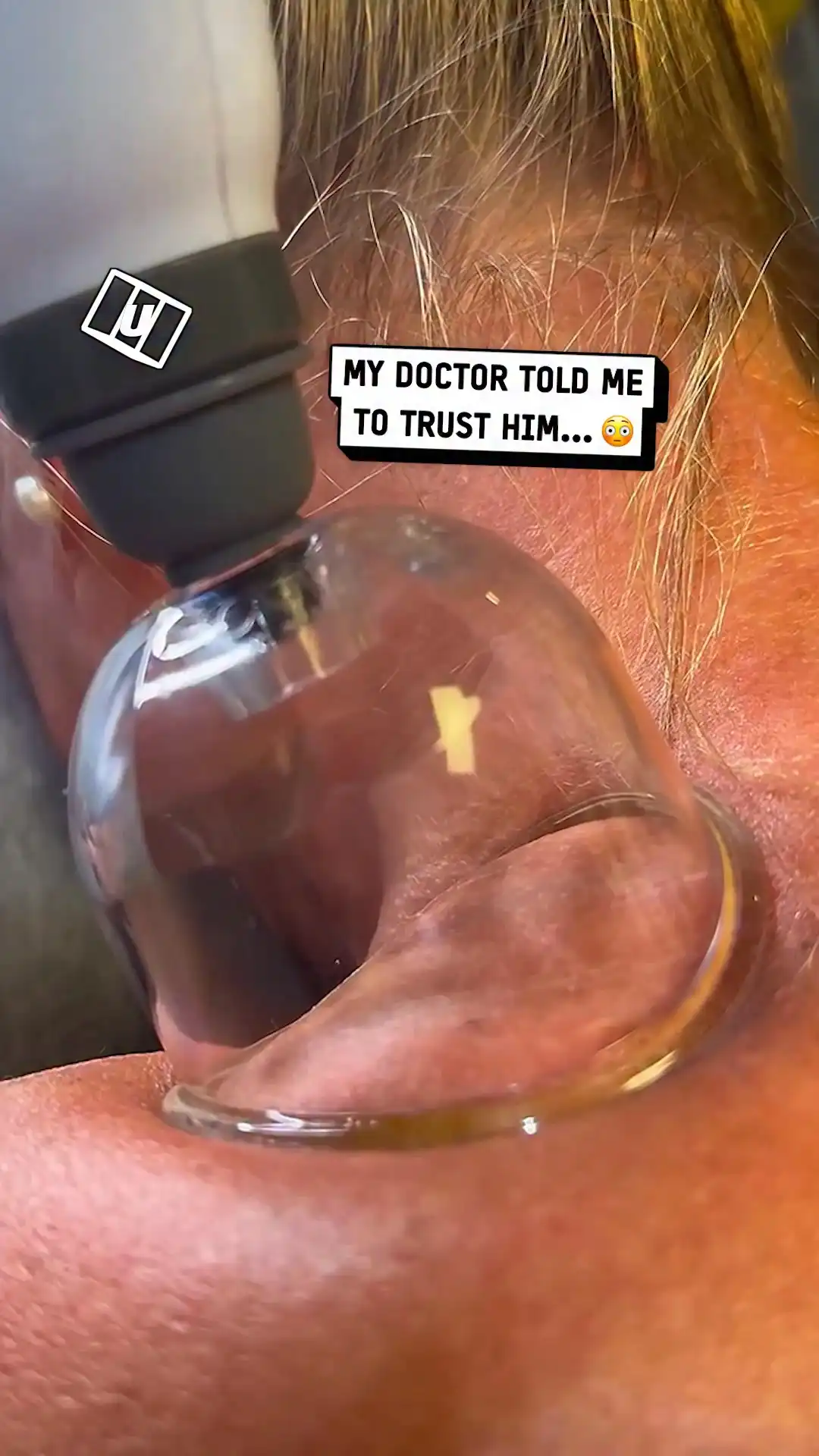 I tried cupping for the first time π²