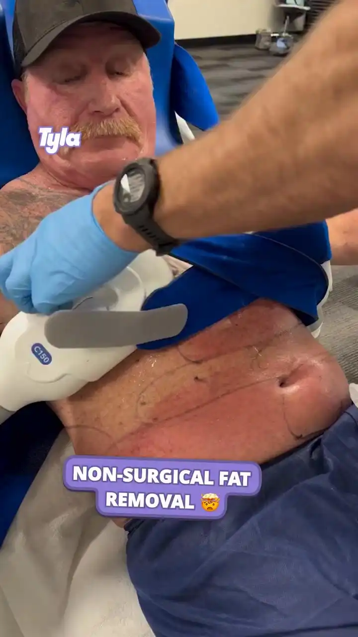 Non-surgical fat removal 🤯👀