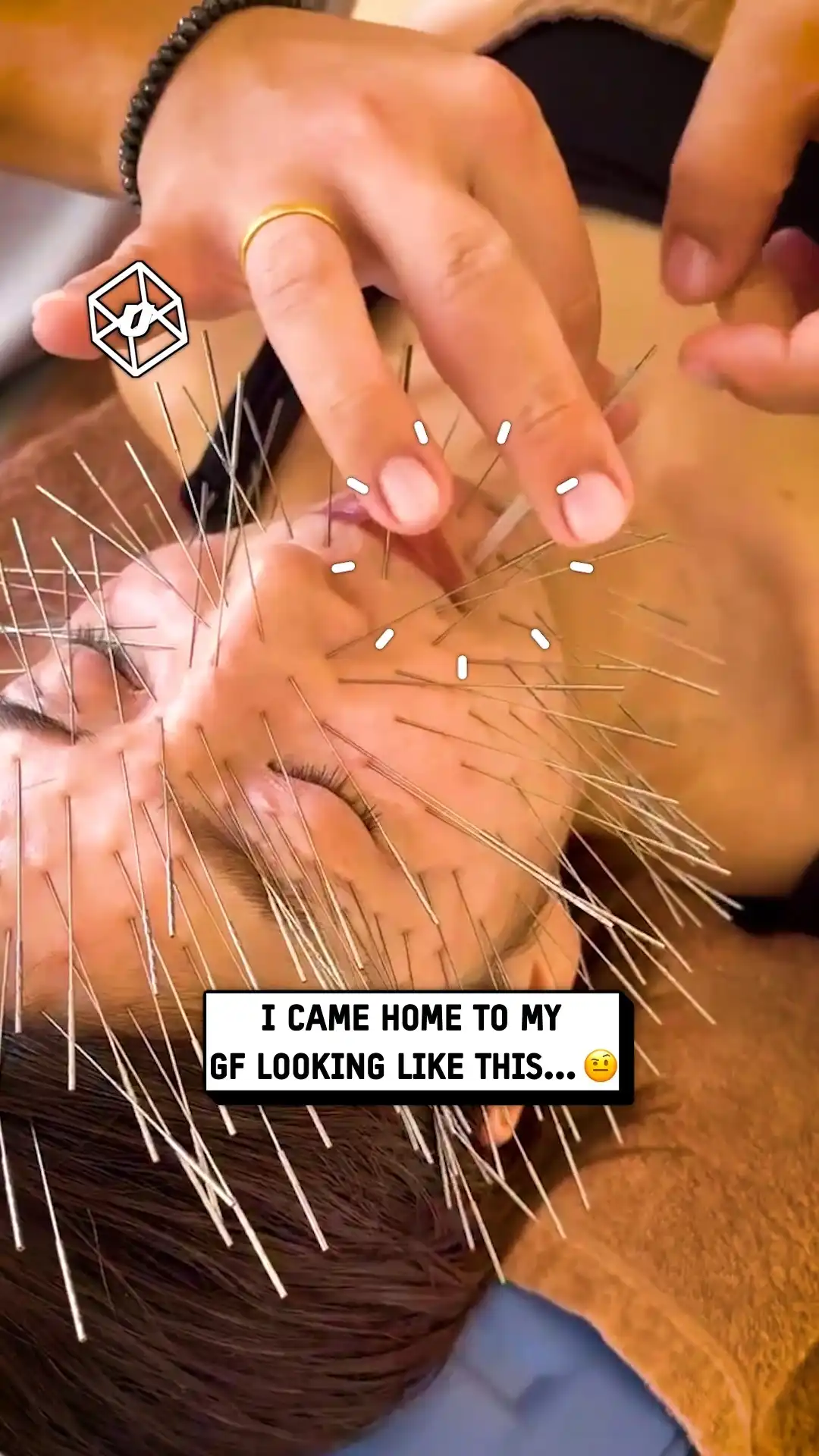 My GF got this insane face needling ๐ณ๐ฒ