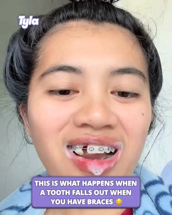Loose tooth still attached to braces 😳