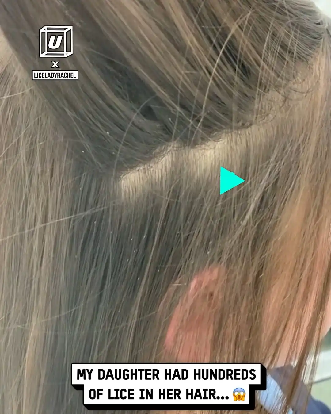 My daughter had hundreds of lice 😳😰