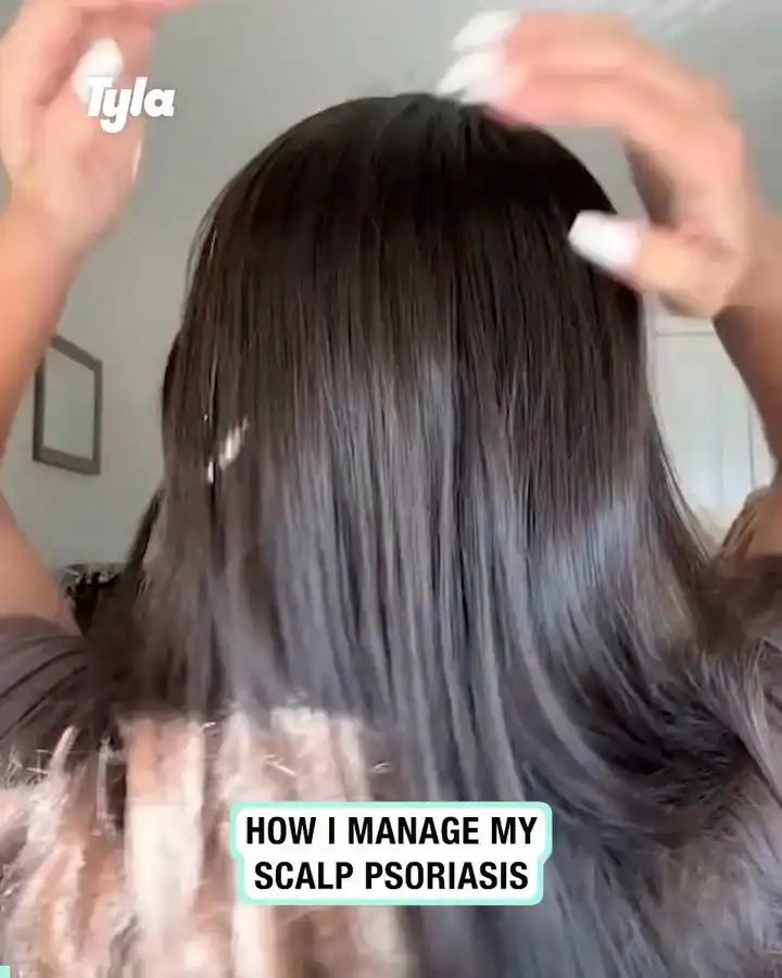 Scalp Psoriasis