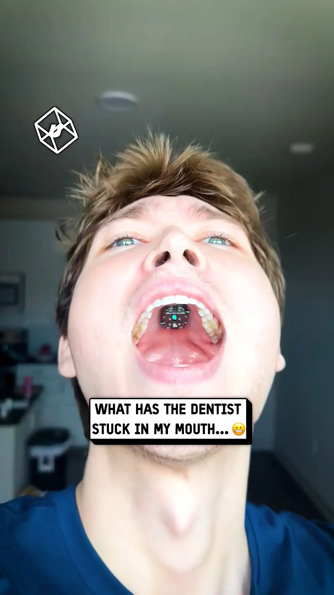 My dentist fitted a palate expander 😳🦷