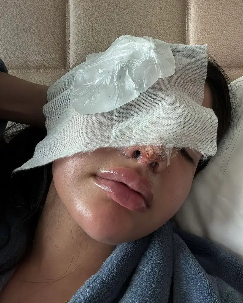 Huda 'Love Island' rhinoplasty