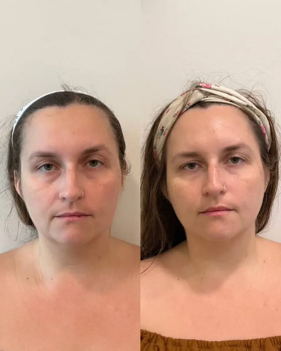 vampire filler ; PRP Injection