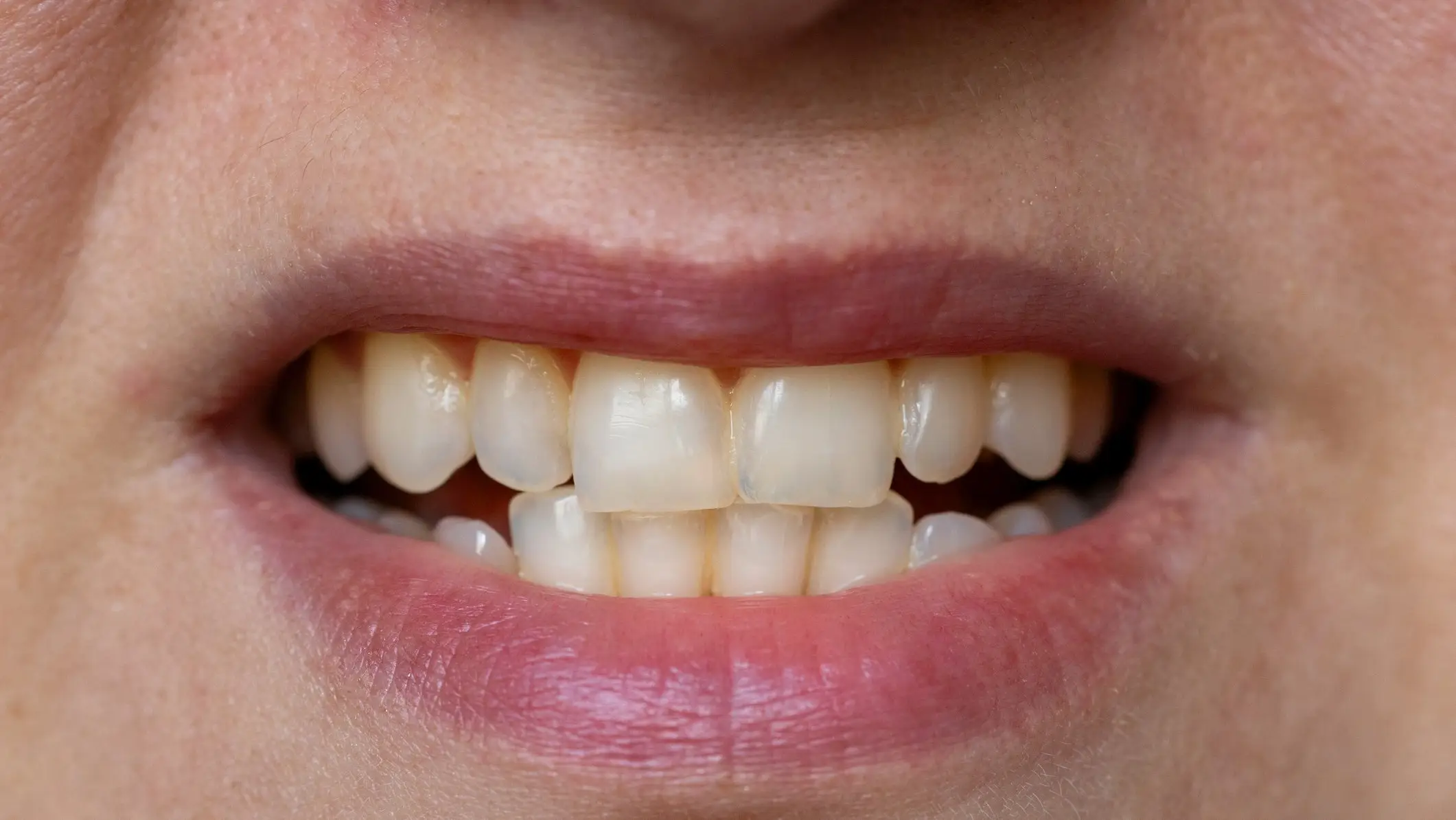 Dentist reveals surprising reason behind why your teeth are yellow
